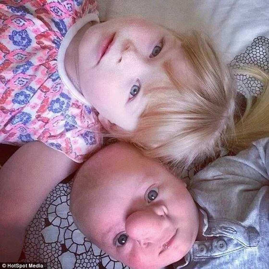 Baby Dubbed Pinocchio After Being Born With Brain In His Nose Baby Dubbed Pinocchio After Being Born With Brain In His Nose
