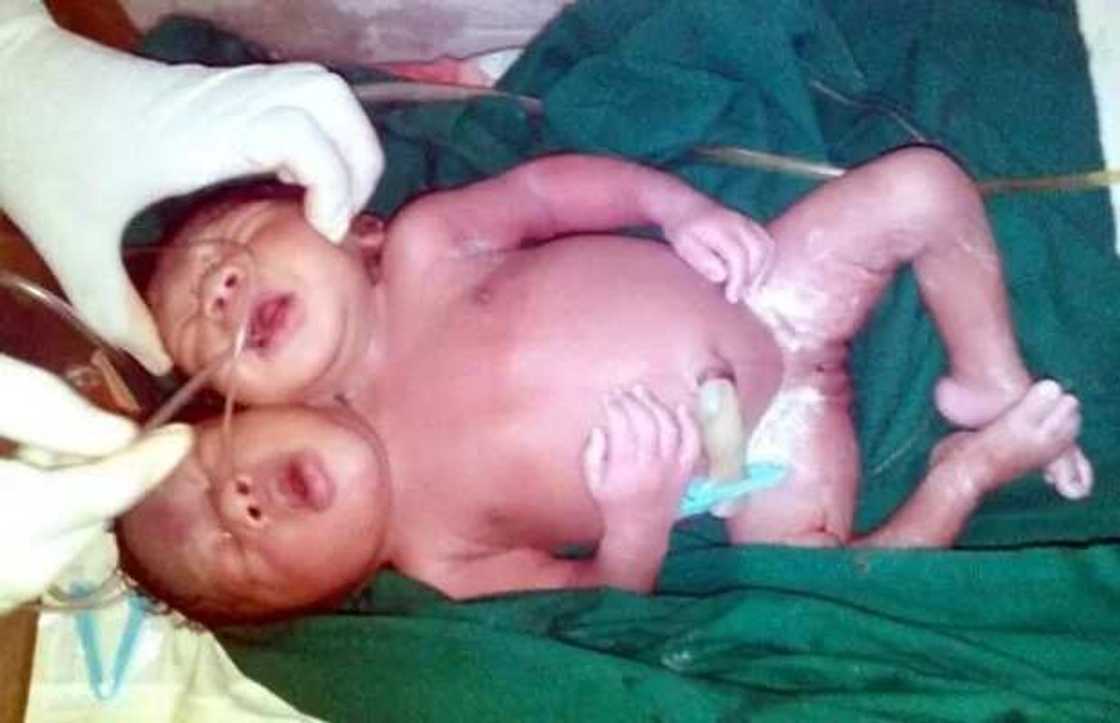 Abin al’ajabi: An haifi jaririya da kawuna 2 a Legas Abin al’ajabi: An haifi jaririya da kawuna 2 a Legas