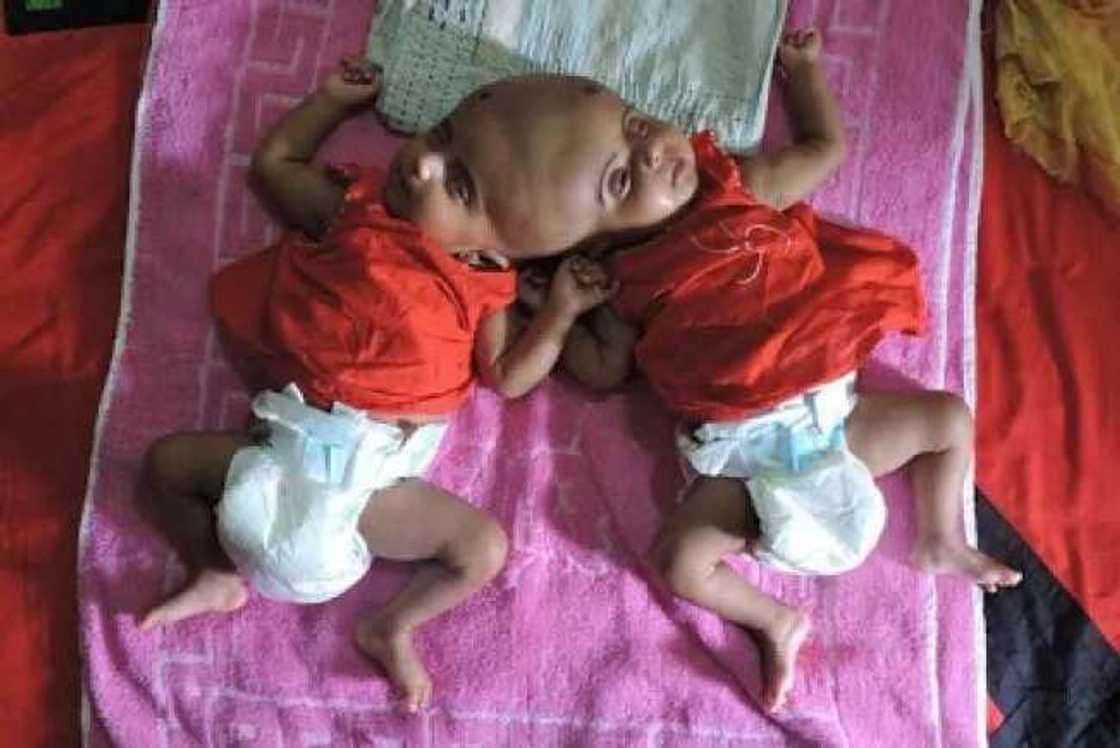 wata mata ta haifi tagwaye masu kai daya a maimakon da daya wata mata ta haifi tagwaye masu kai daya a maimakon da daya