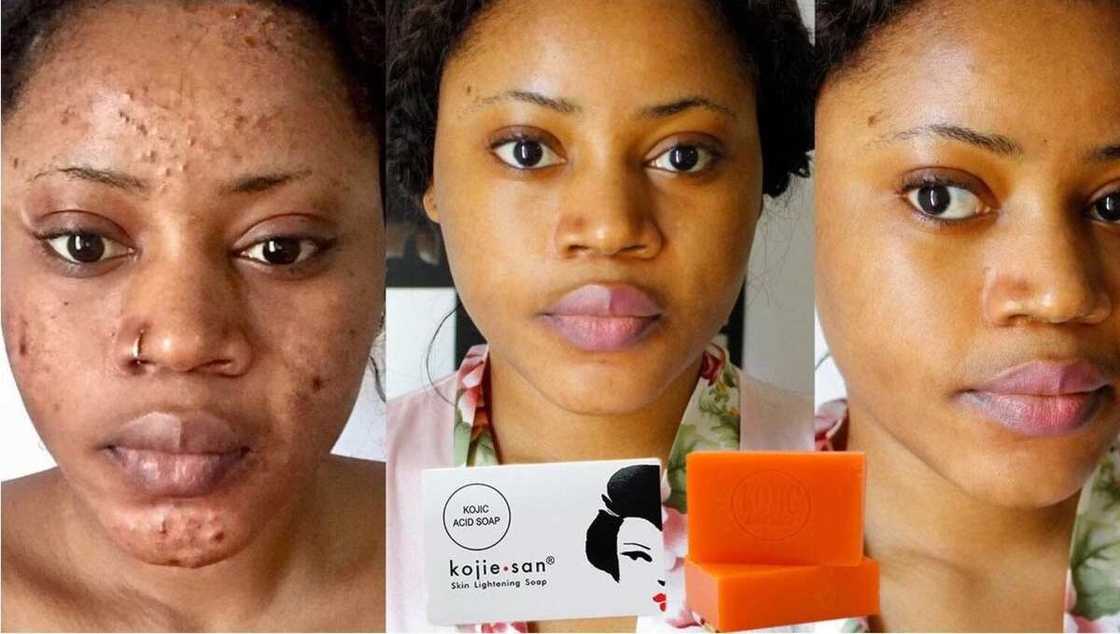 Kojic acid soap side effects