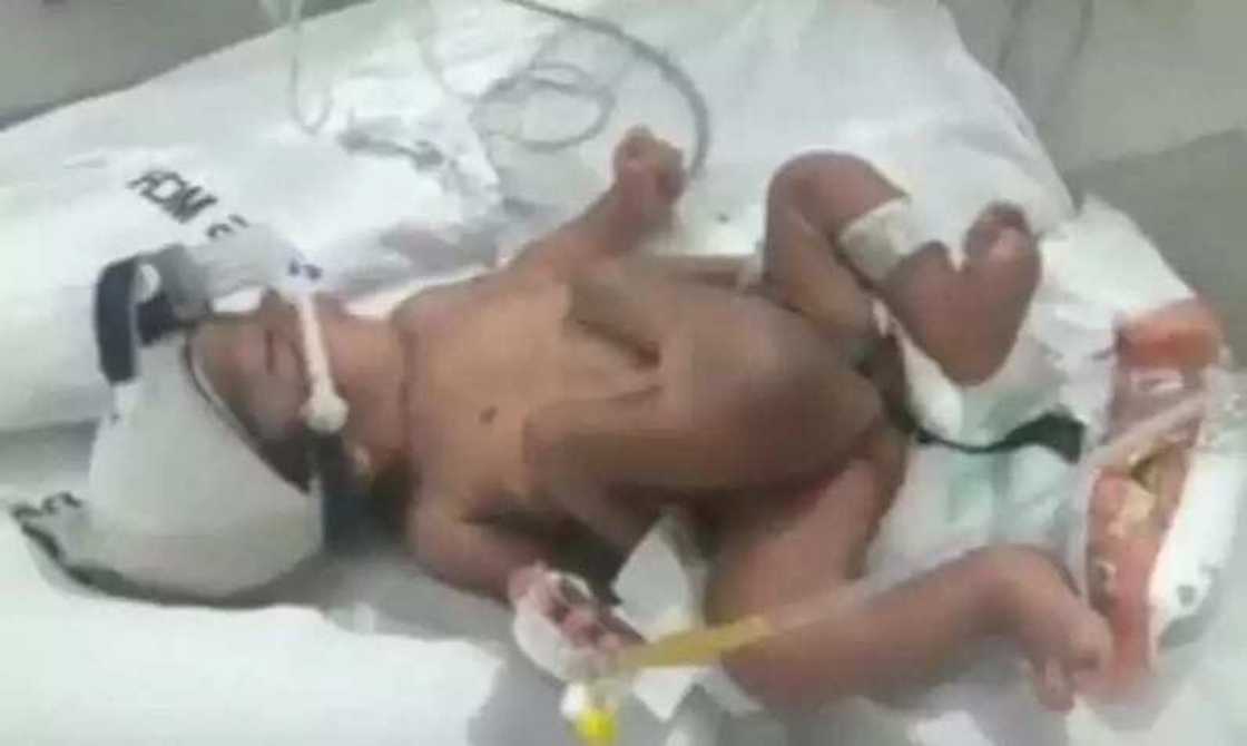 An haifi wani jariri a kasar Indiya mai kafa 4 mazakuta 2 (Hotuna) An haifi wani jariri a kasar Indiya mai kafa 4 mazakuta 2 (Hotuna)