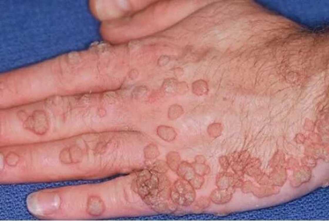 Kiwon lafiya: Bayani game da cutar HPV 'Papiloma' Kiwon lafiya: Bayani game da cutar HPV 'Papiloma'