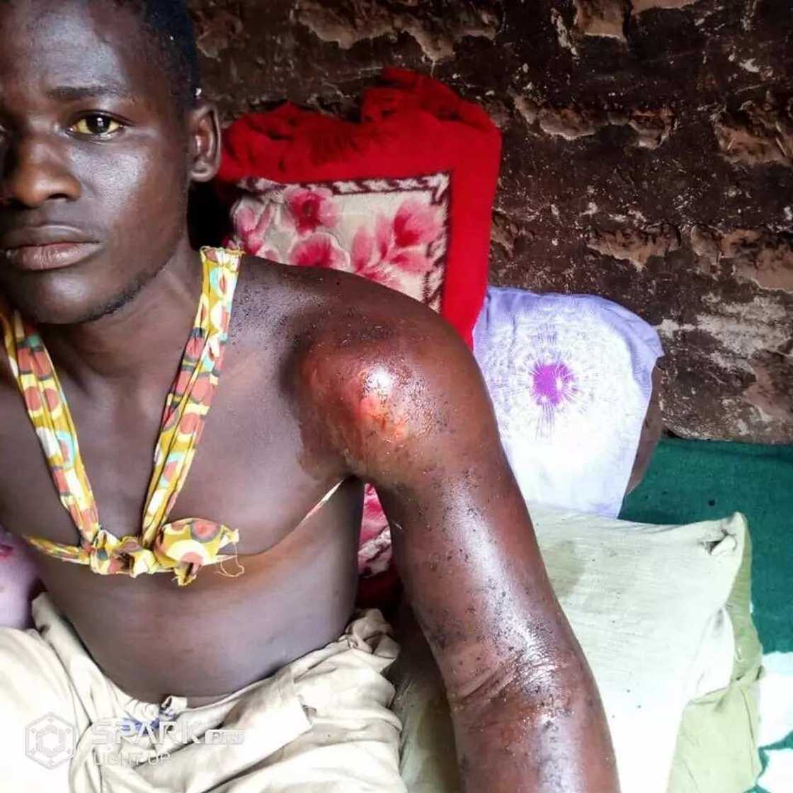 Hannun wani matashi da ‘yan sanda suka yiwa dukan tsiya ya fara rubewa, kalli hotuna Hannun wani matashi da ‘yan sanda suka yiwa dukan tsiya ya fara rubewa, kalli hotuna