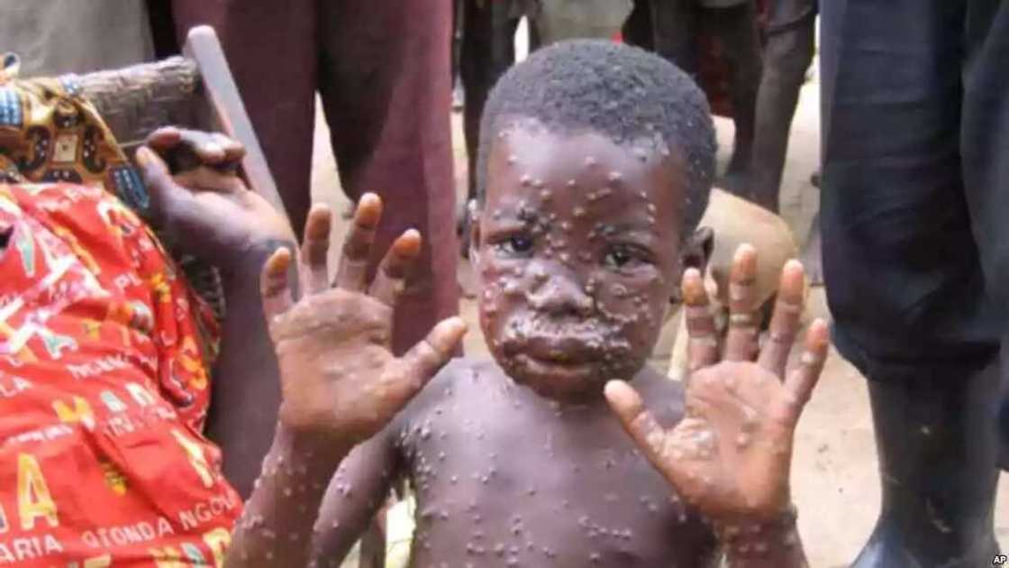 Wata sabuwar cuta makamanciyar kyanda ta barke a jihar Bayelsa, an killace mutane 10 tare da likita guda Wata sabuwar cuta makamanciyar kyanda ta barke a jihar Bayelsa, an killace mutane 10 tare da likita guda