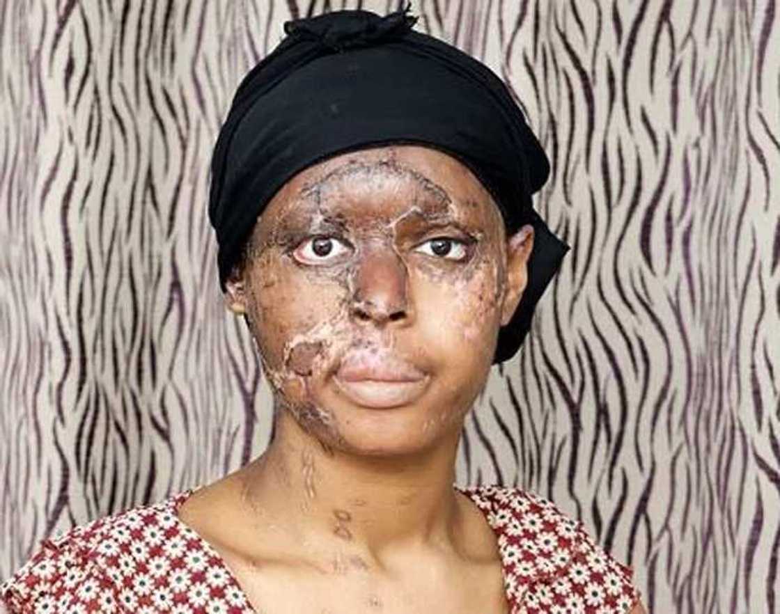 14 Acid attacks