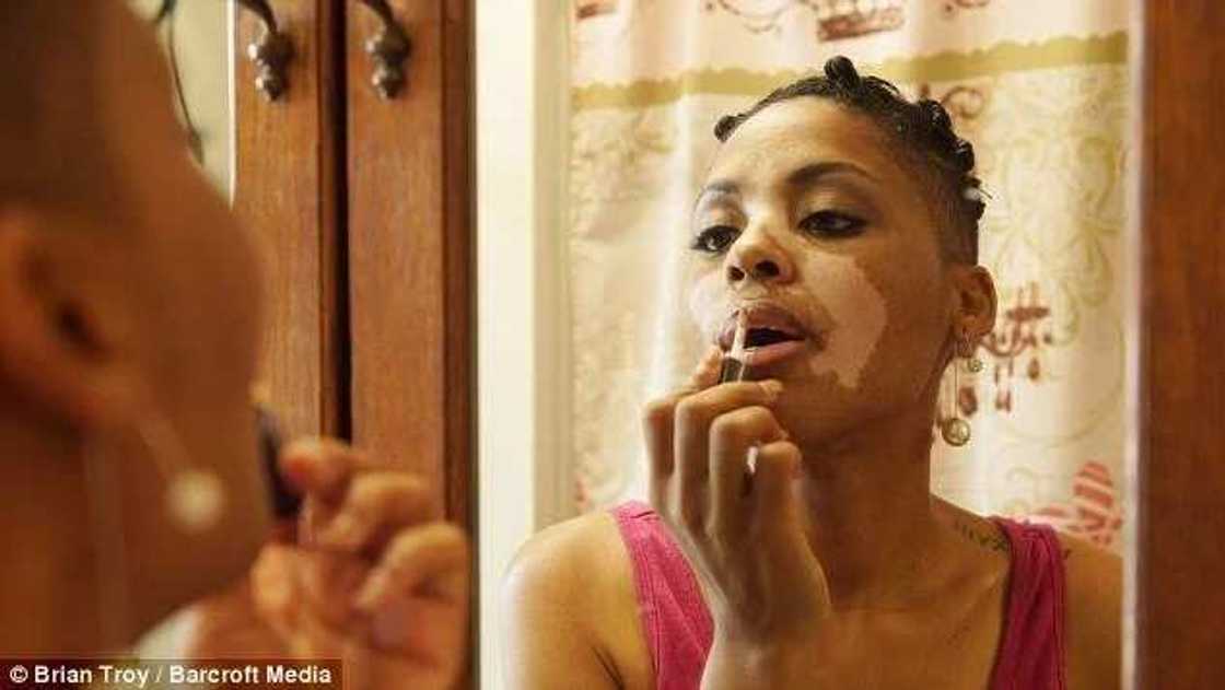 Black Woman With Vitiligo Tells Her Touching Story Black Woman With Vitiligo Tells Her Touching Story