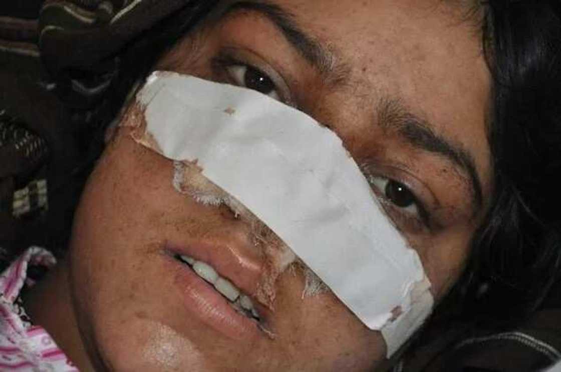 Woman's Nose Cut Off By Her Husband Of Five Years Woman's Nose Cut Off By Her Husband Of Five Years