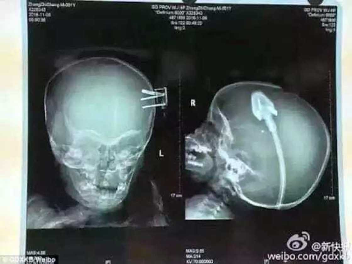 Kan wayar wuta ya caki kan Jariri Kan wayar wuta ya caki kan Jariri