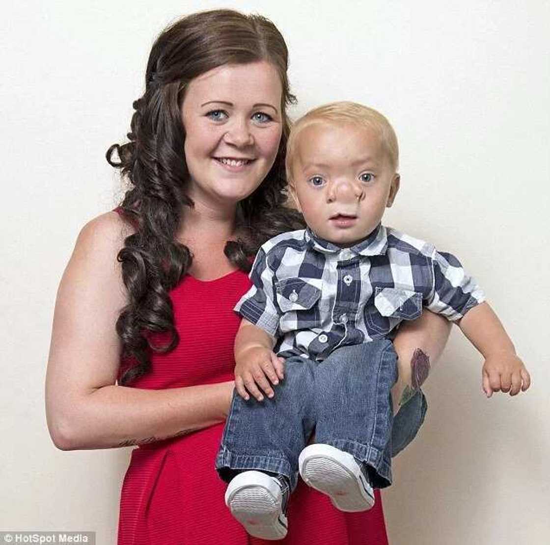 Baby Dubbed Pinocchio After Being Born With Brain In His Nose