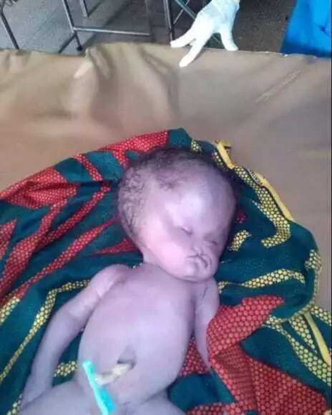 An haifi wani yaro da nakasa a kai saboda mahaifiyar shi An haifi wani yaro da nakasa a kai saboda mahaifiyar shi