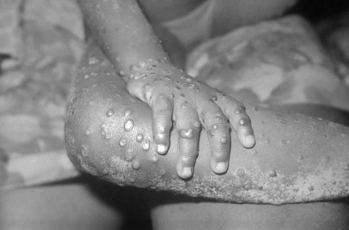10 major facts about the monkeypox virus 10 major facts about the monkeypox virus