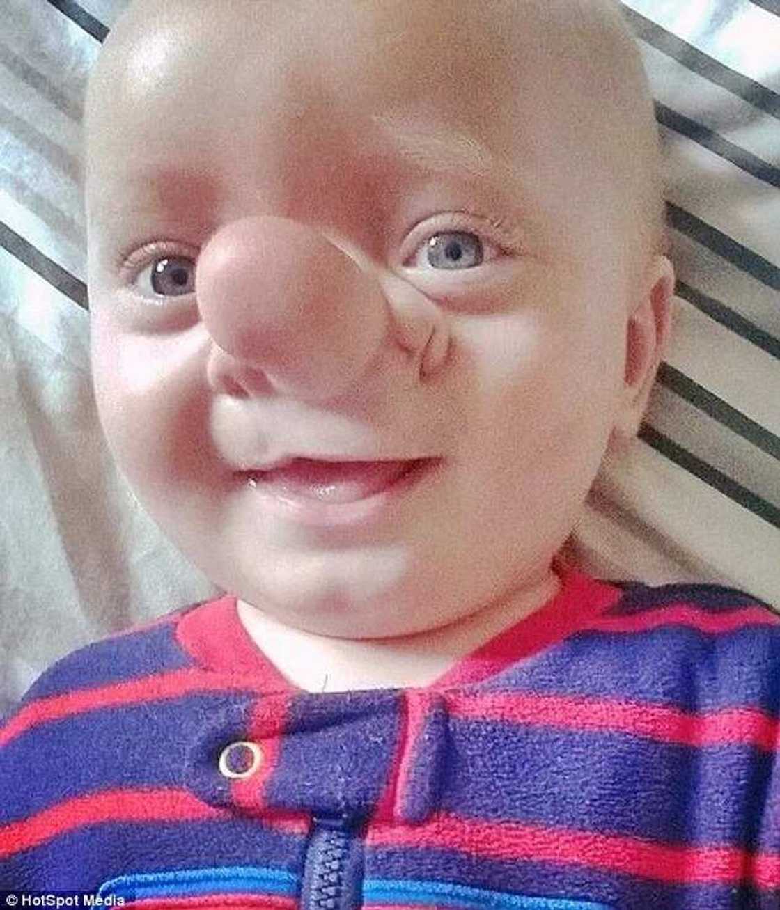 Baby Dubbed Pinocchio After Being Born With Brain In His Nose