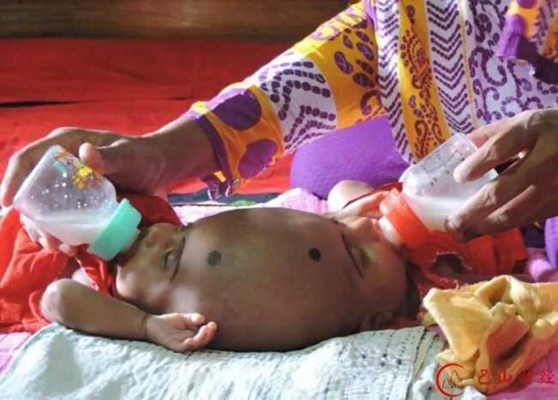 wata mata ta haifi tagwaye masu kai daya a maimakon da daya wata mata ta haifi tagwaye masu kai daya a maimakon da daya