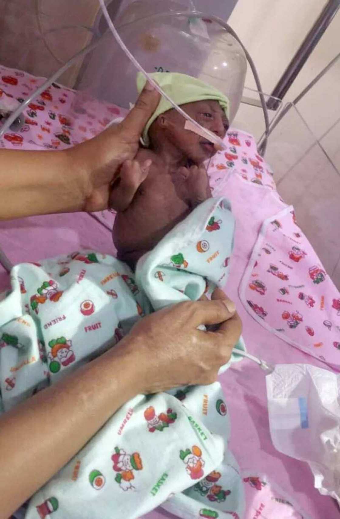 Newborn Baby Abandoned By Parents Due To Wrinkly Skin Newborn Baby Abandoned By Parents Due To Wrinkly Skin