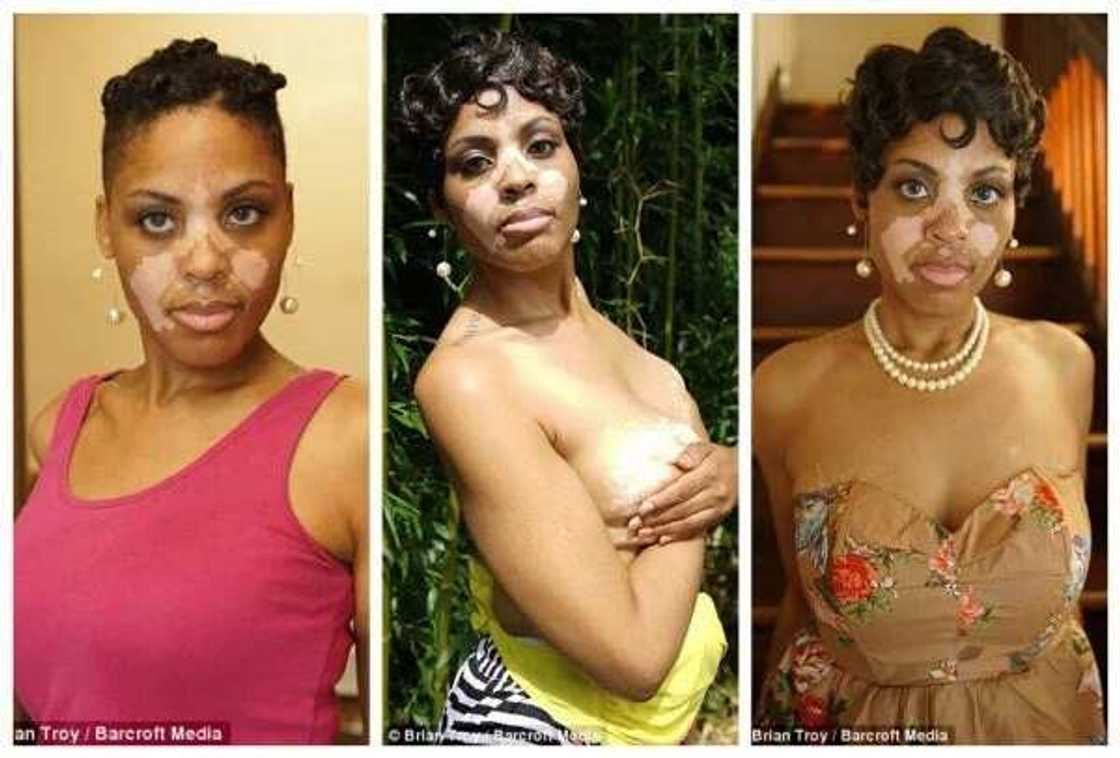 Black Woman With Vitiligo Tells Her Touching Story Black Woman With Vitiligo Tells Her Touching Story