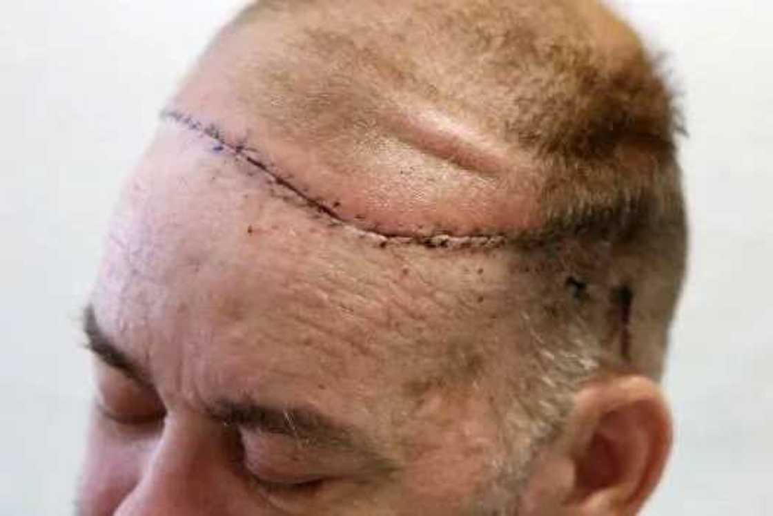 Doctors Perform World's First Skull-Scalp Transplant Doctors Perform World's First Skull-Scalp Transplant