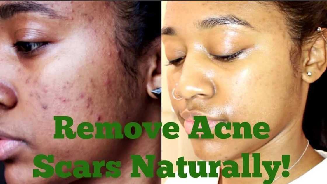 Carrot oil for acne Carrot oil for acne