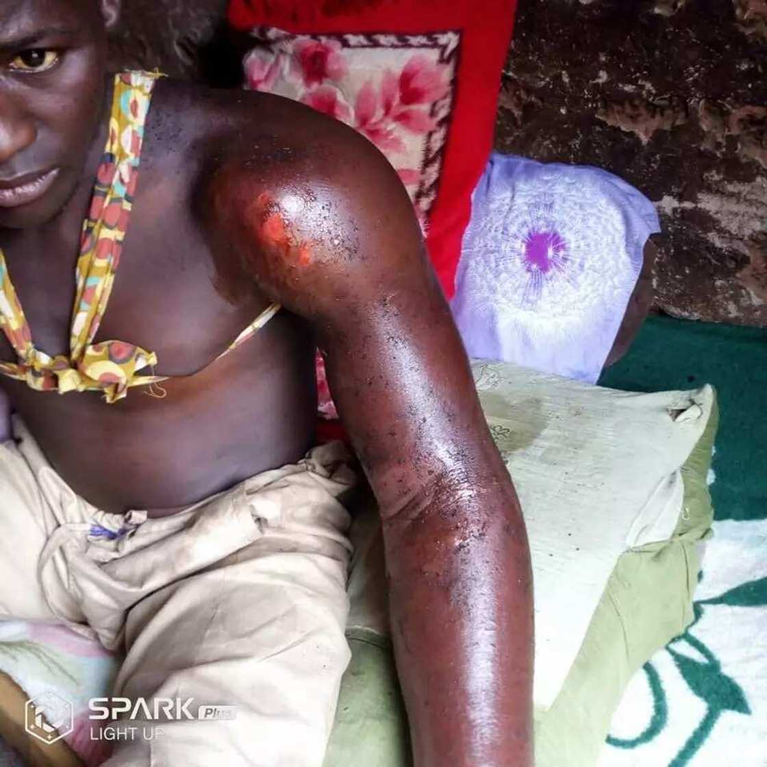 Hannun wani matashi da ‘yan sanda suka yiwa dukan tsiya ya fara rubewa, kalli hotuna Hannun wani matashi da ‘yan sanda suka yiwa dukan tsiya ya fara rubewa, kalli hotuna