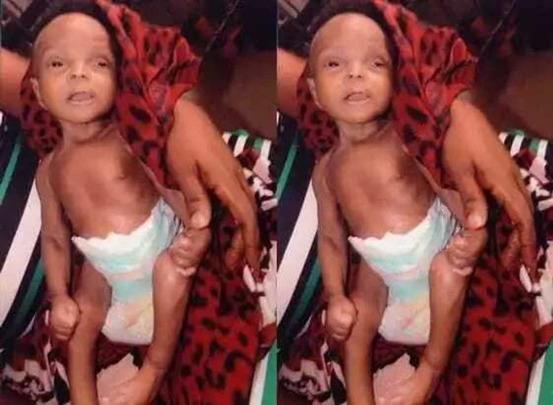 An haifi jariri ba tare da dubura ko mazakuta ba An haifi jariri ba tare da dubura ko mazakuta ba