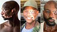 "I shunned all negativity": Man who was bullied over rare skin condition becomes top model, story inspires people