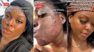 "Costs less than N1k": Lady who battled severe acne shares skincare routine that gave her glass skin