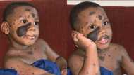 Adorable photos of a boy looking cute with his birthmarks go viral