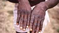 10 things you should know about the monkeypox virus