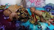 Dubi Hotunan wasu Tagwaye da Likitoci suka raba bayan an haife su manne da juna a jihar Adamawa