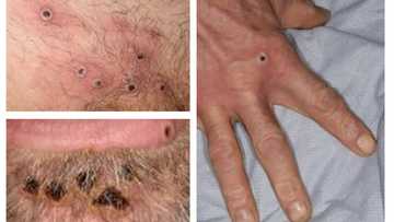 WHO emergency committee meets on monkeypox