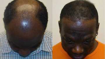 Abuja man reveals how he cured baldness and severe hair loss within 14 days using a natural herbal remedy
