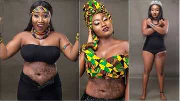 Burns do not stop me from being a queen - Nigerian survivor shows off her scars (photos)