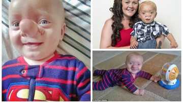 PHOTOS: Meet Baby Boy Born With His Brain Growing Into Nose