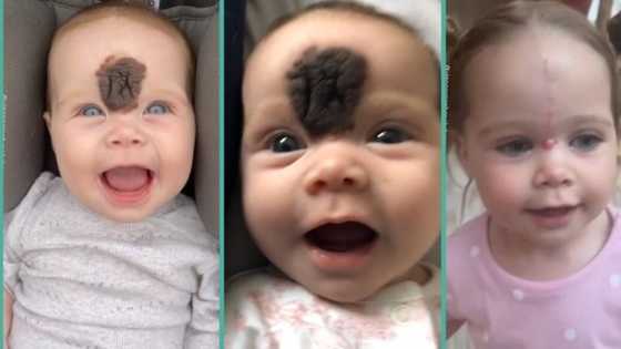"She would have felt like an outsider": Parents take decision to remove baby's birthmark in video