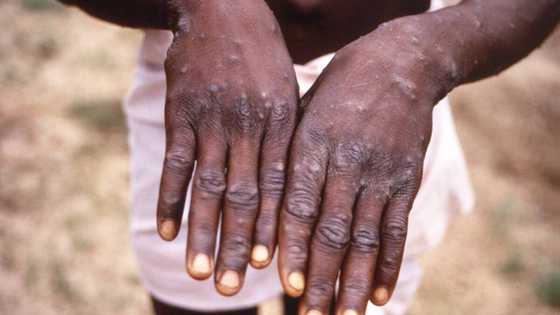 US health officials warn: Spread of monkeypox high among gay, bisexual
