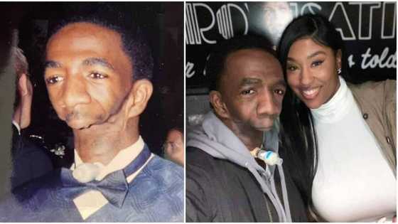 41-year-old man born without jaw finds love, marries cute lady, their stunning story goes viral
