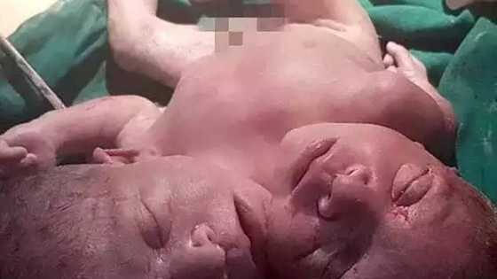 Allah mai halitta: An haifi wani jariri mai kai biyu a kasar Indiya (Hotuna)