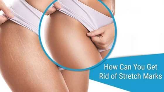 Natural remedies for dealing with stretch marks